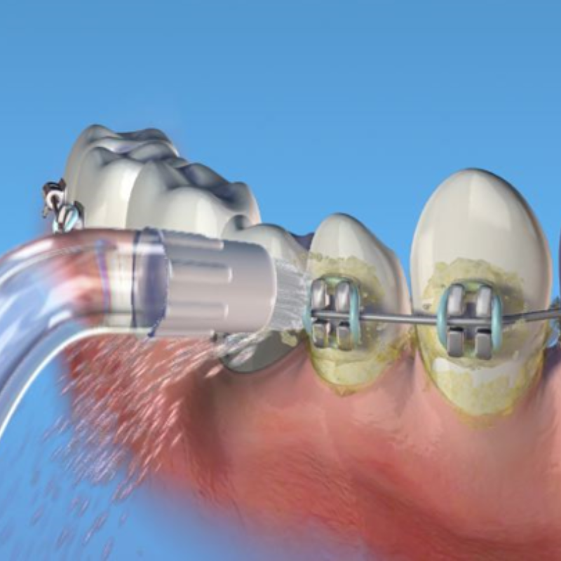 Bico Ortodôntico Waterpik - Orthodontic Tip